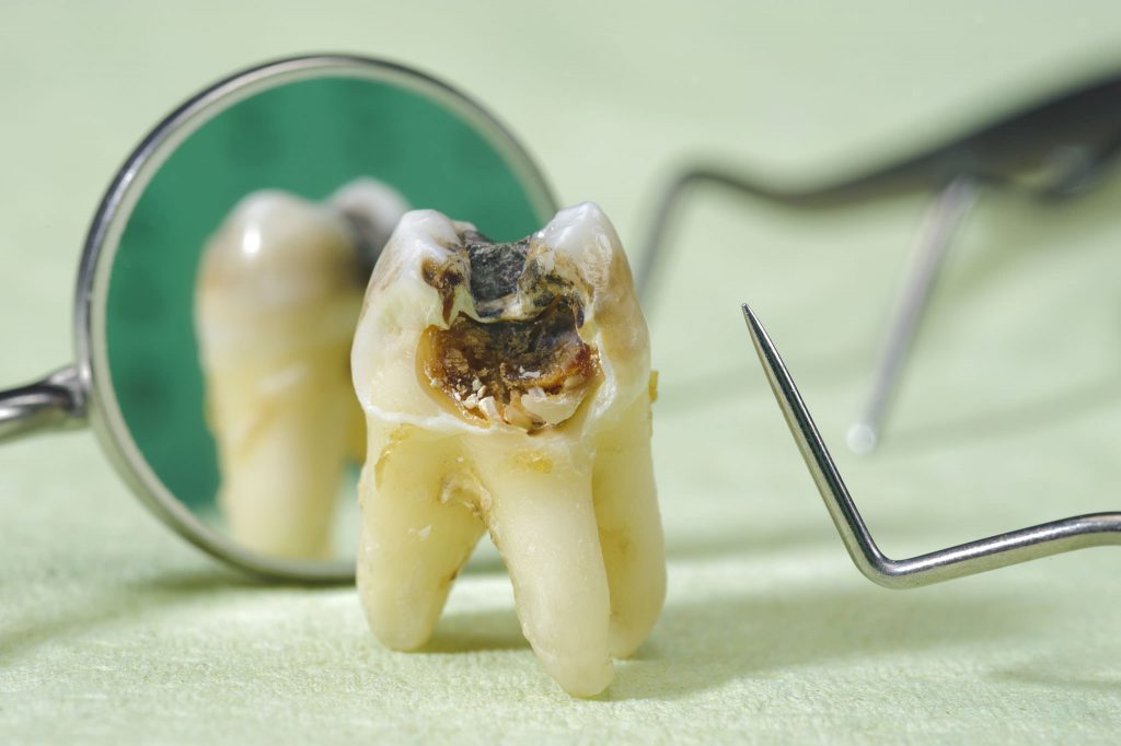 Extracted tooth showing extreme dental decay.