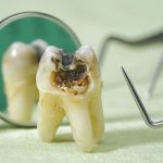 Extracted tooth showing extreme dental decay.