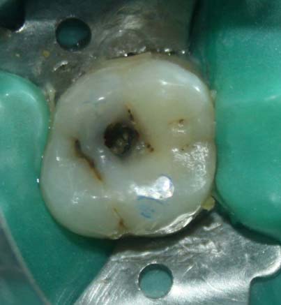 BPA Free Composite Filling - Before