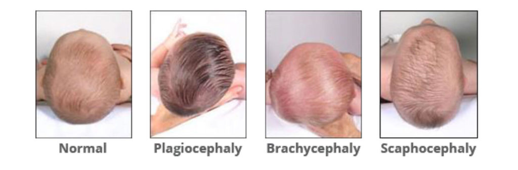 Normal - Plagiocephaly - Brachycephaly - Scaphocephaly top view examples