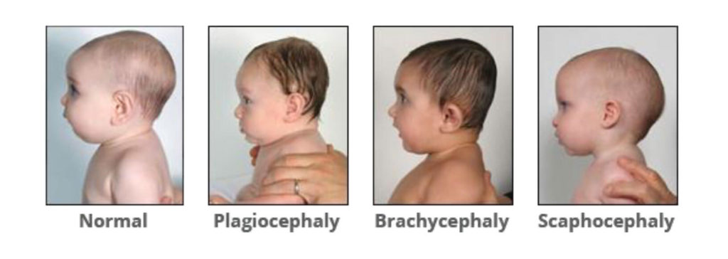 Normal - Plagiocephaly - Brachycephaly - Scaphocephaly side view examples