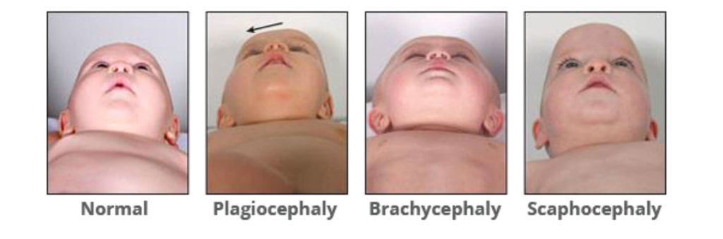 Normal - Plagiocephaly - Brachycephaly - Scaphocephaly front examples