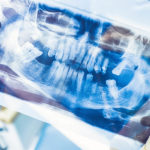 Dental X-Rays - Healthy bodies can protect against cumulative exposure.
