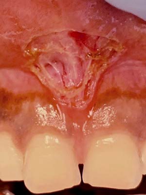 Adult Frenectomy - Upper - After