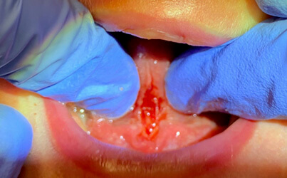 Infant Frenectomy - Lower - After