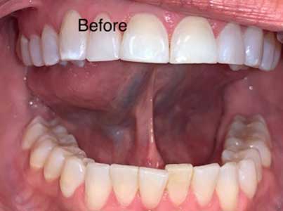 Adult Frenectomy - Lower - After