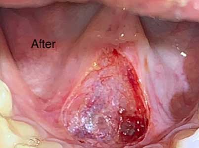 Adult Frenectomy - Lower - Before