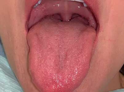Adult Frenectomy - Lower - Before