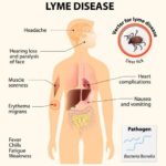 Lyme disease and the dental connection. Lyme bacteria exists in the teeth, not in the enamel. The spirochete bacterium love to occupy in the dentin and some up to three miles of tiny tubules.
