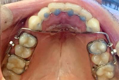 Anterior Growth Guidance Appliance (AGGA) - After