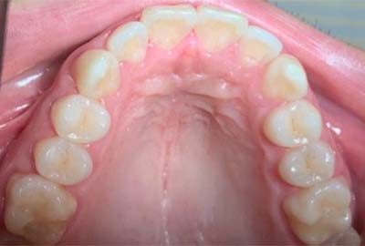 Anterior Growth Guidance Appliance (AGGA) - Before