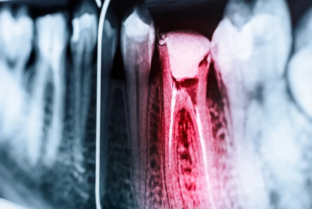 X-Ray of Infected Tooth