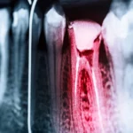 X-Ray of Infected Tooth